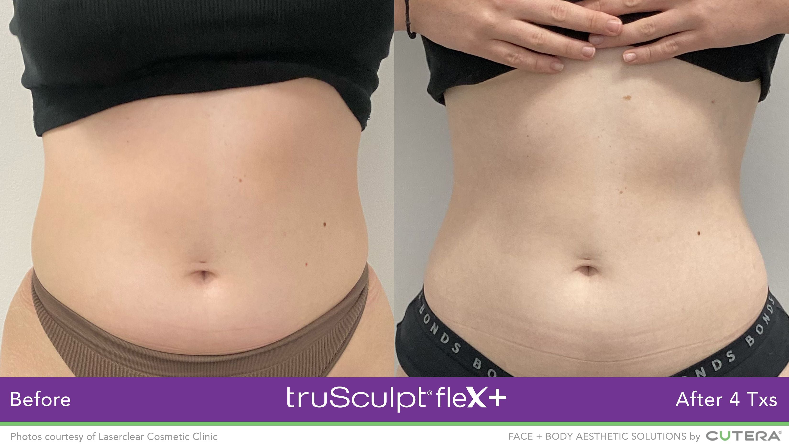 truSculpt Flex Results Image -6398c9312992d